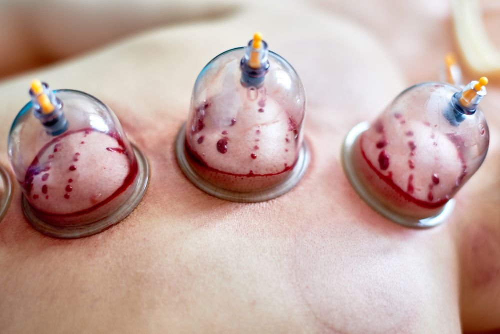 Hijama Therapy