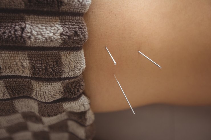 Needling Therapy