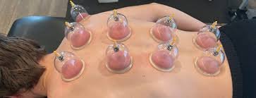 Conditions Treated with Cupping